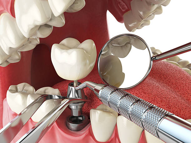 Best Emergency Dental Care for Broken or Chipped Teeth in Eagle, ID